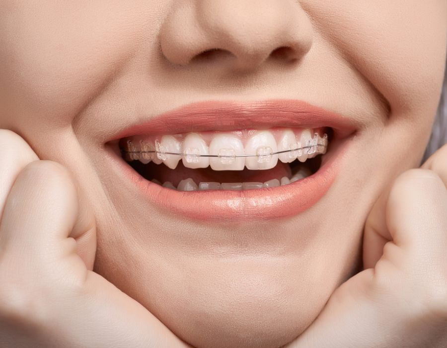 brackets transparentes en Clinica Dental en Alicante